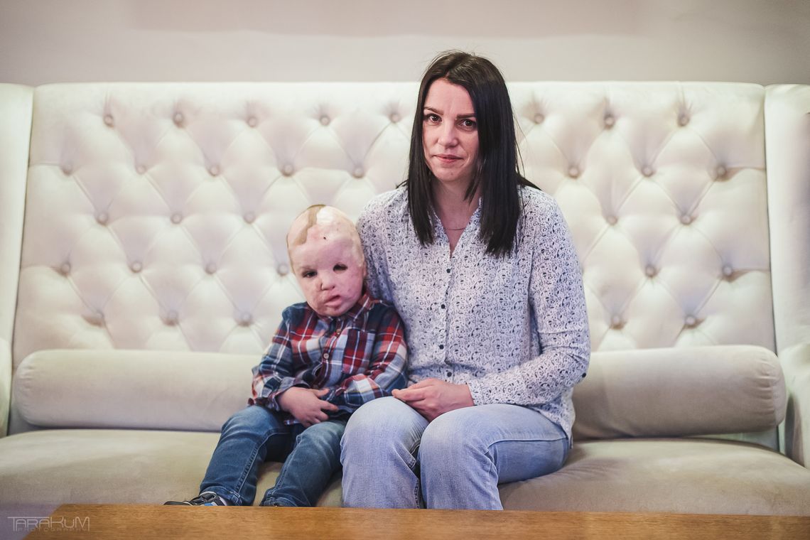 Światowej sławy chirurg wrócił do Gdańska. Pomoże Frankowi i innym poparzonym dzieciom